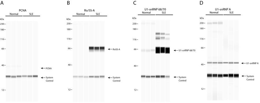 Simple Western Test Results Showing Autoantibodies Detection in Lupus Patient Serum. Neither Patient had Autoantibodies for PCNA (A). Only the SLE Patient had Ro/SS-A Autoantibodies (B). Both Patients had Equivalent Amounts of U1-snRNP A (D). The SLE Patient had 40X More U1-snRNP 68/70 Compared to the Normal Patient (C)